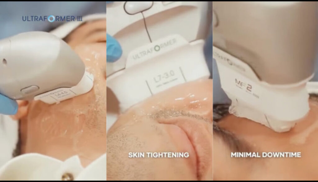 MOLD Manila Shares the Spotlight on Ultraformer Deep Dive (1)